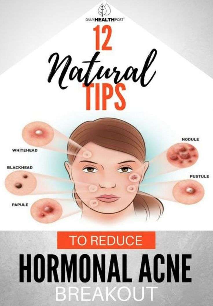 12 Natural Tips To Reduce Hormonal Acne Breakout  Toned
