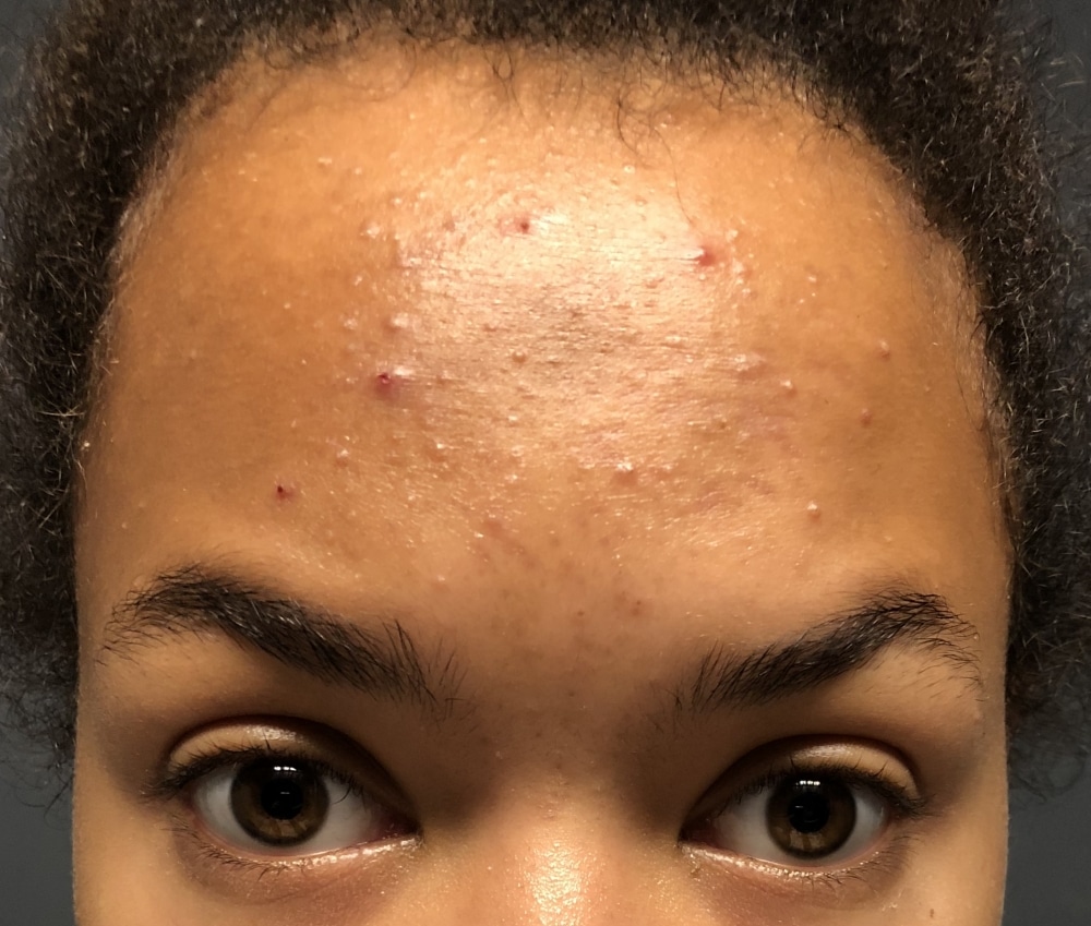 15 yr old, acne :( (pictures)