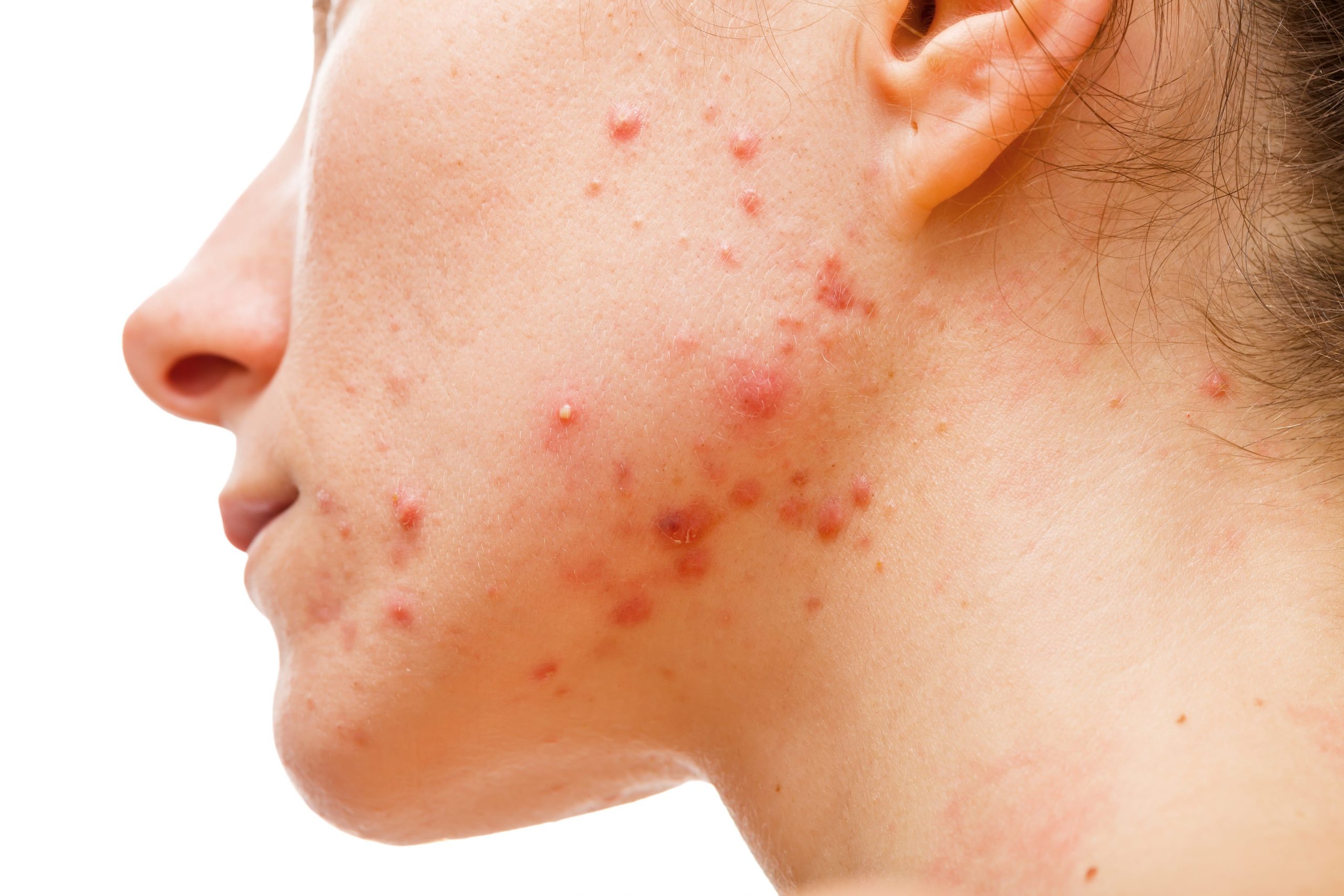4 Signs You Are Experiencing Hormonal Acne