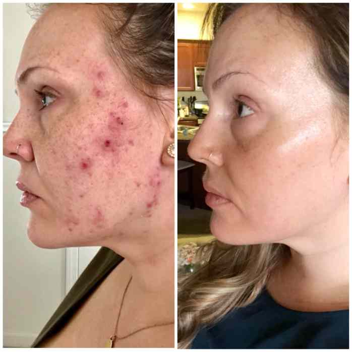 Accutane for Adult Acne: My Experience