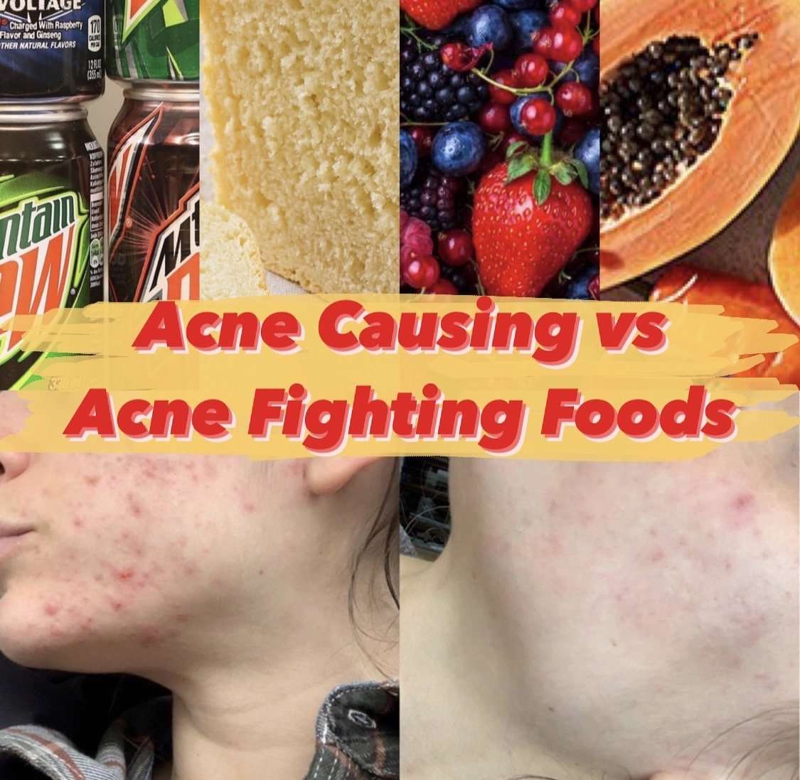 Acne Causing vs Acne Fighting Foods