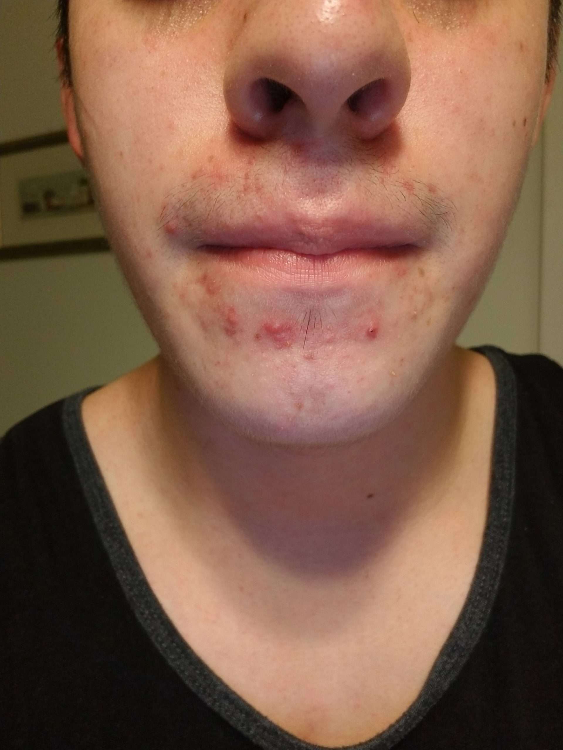 [Acne] Consistent acne around mouth and chin ...