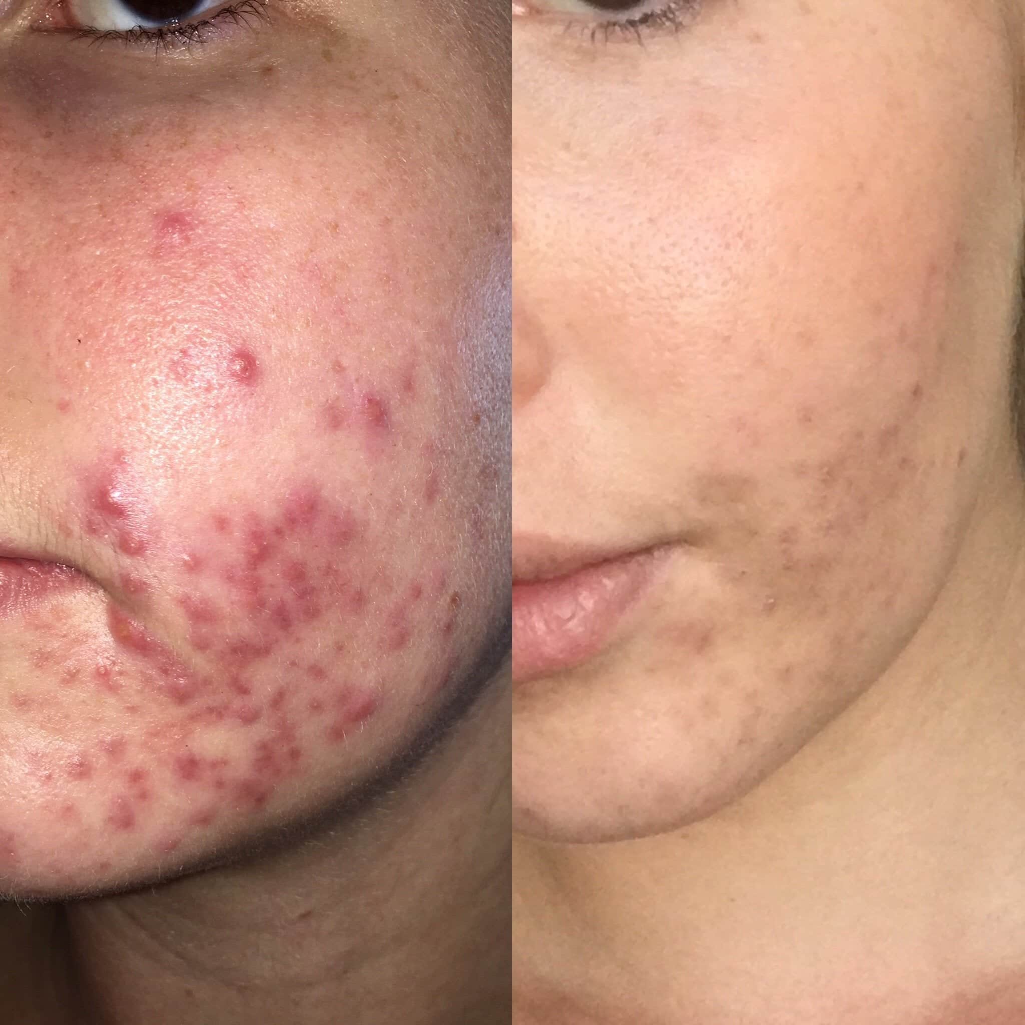 [Acne] Cystic and Hormonal Acne gone!! : SkincareAddiction