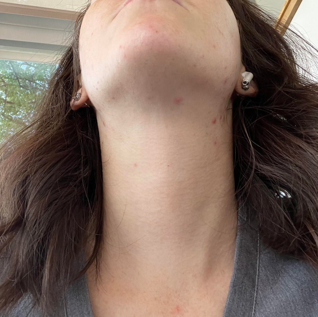 [Acne] how can I tell if this is hormonal? : r/SkincareAddiction