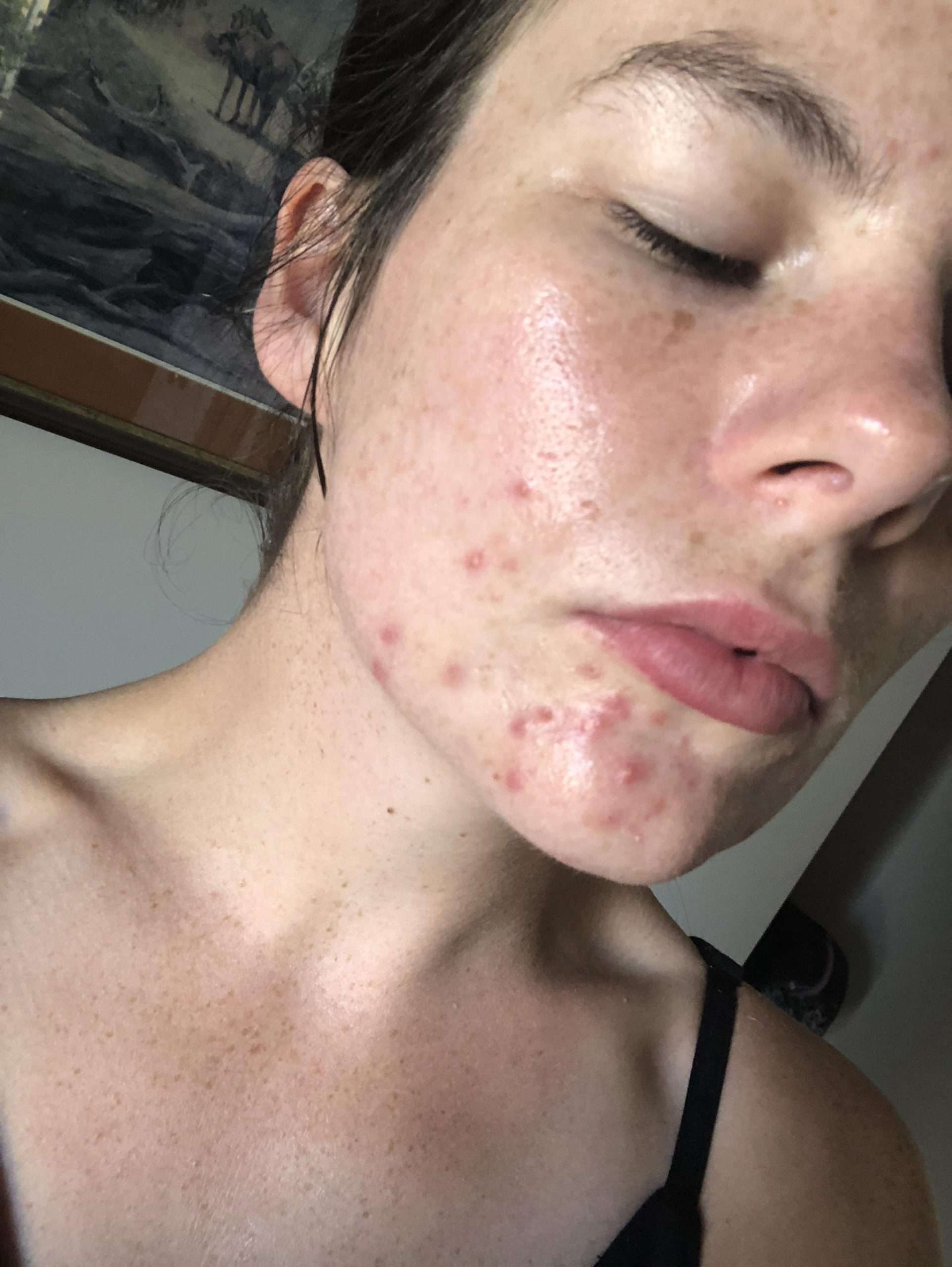 [Acne] I need help tackling hormonal acne! : SkincareAddiction
