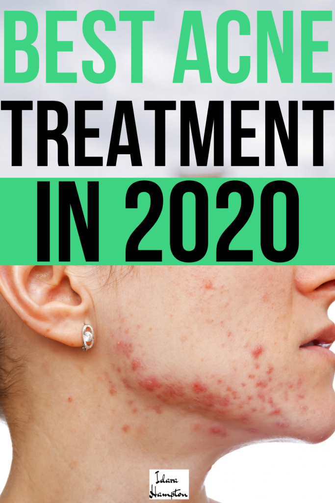 Acne Treatment 101: How to Get Clear Skin in 2020