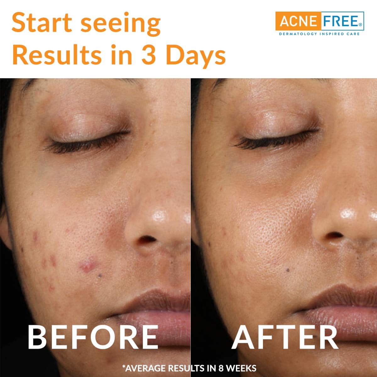 Acne Treatment Doxycycline