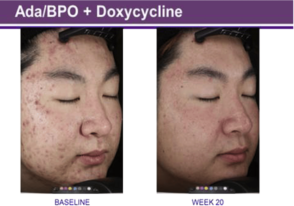 Acne Treatment Doxycycline