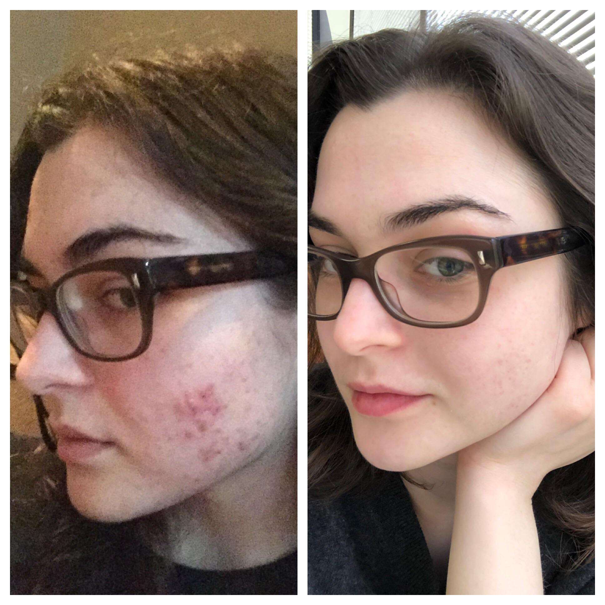 [B& A] 18 months progress hormonal cystic acne : SkincareAddiction