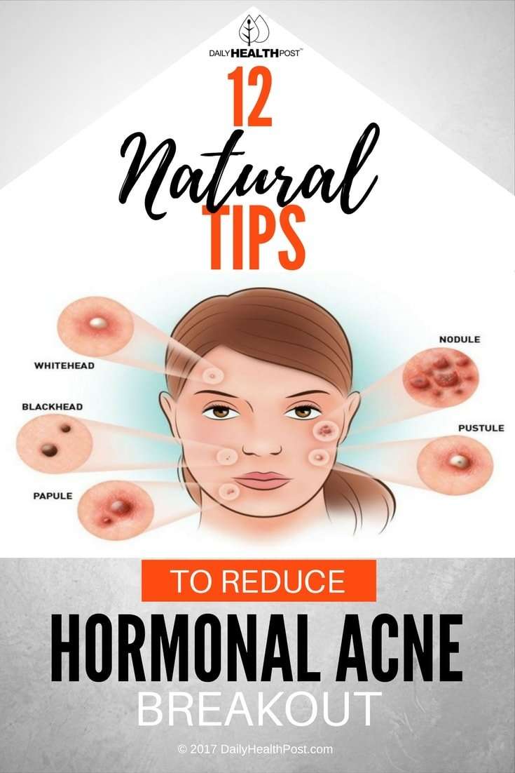Beat The Breakout: 12 Naturals Ways To Get Hormonal Acne ...