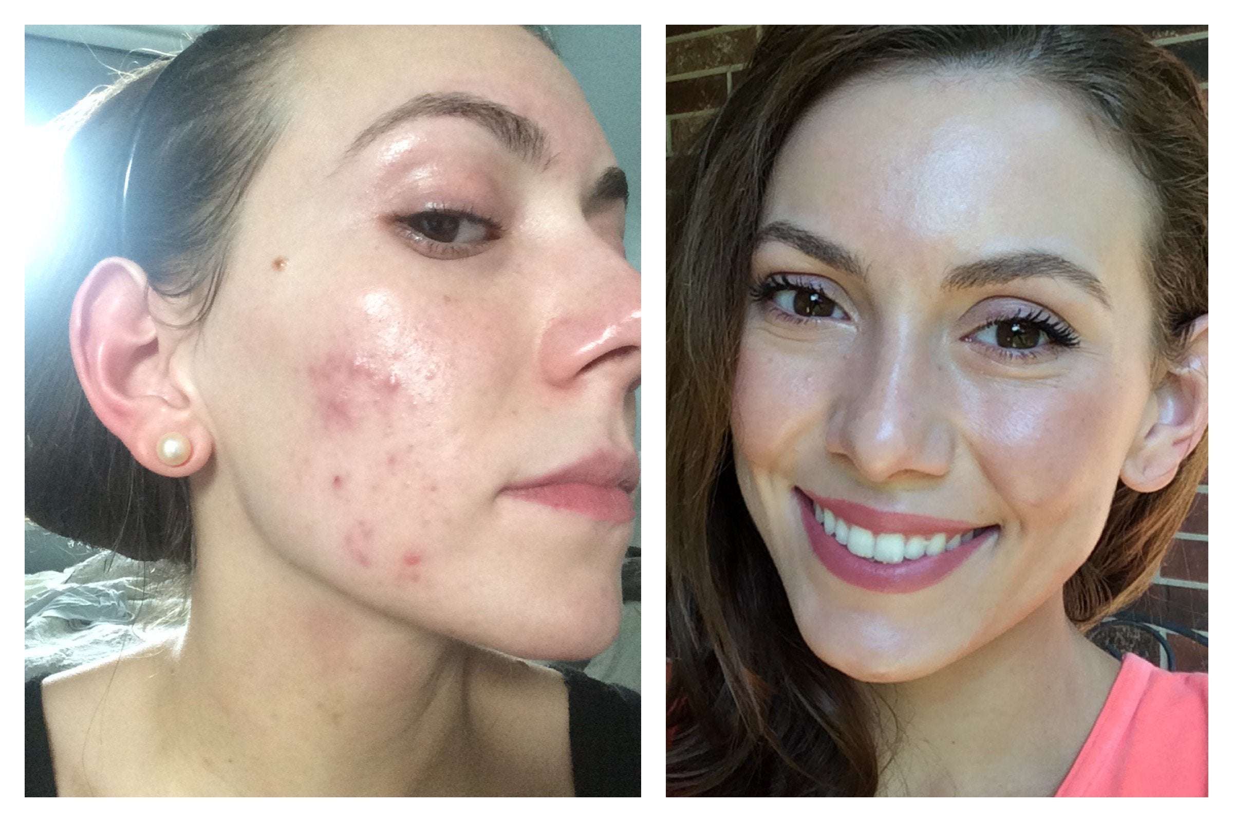 [Before&After] 6 months of hormonal acne treatment later ...