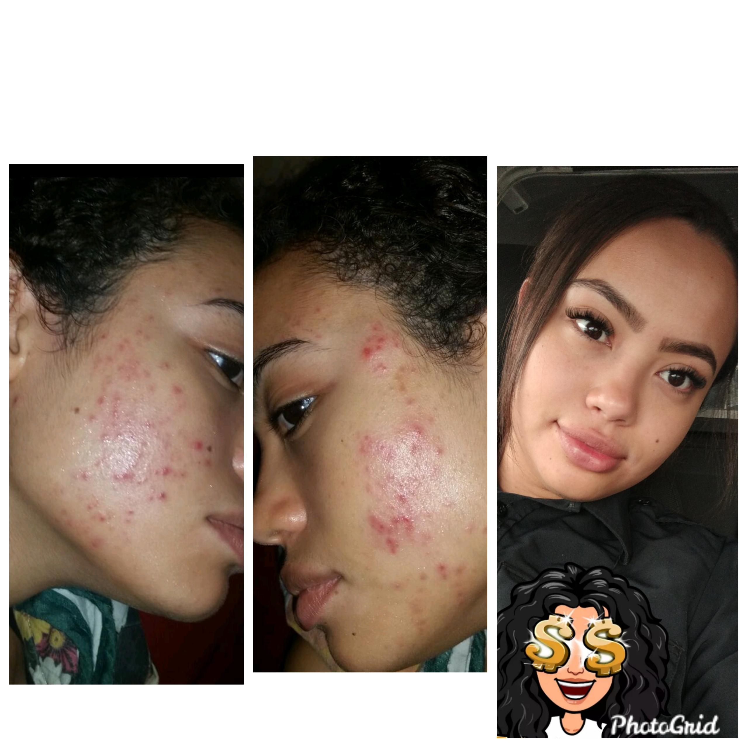 Before &  After.. Dry, sensitive, hormonal acne. Dermatologist did ...
