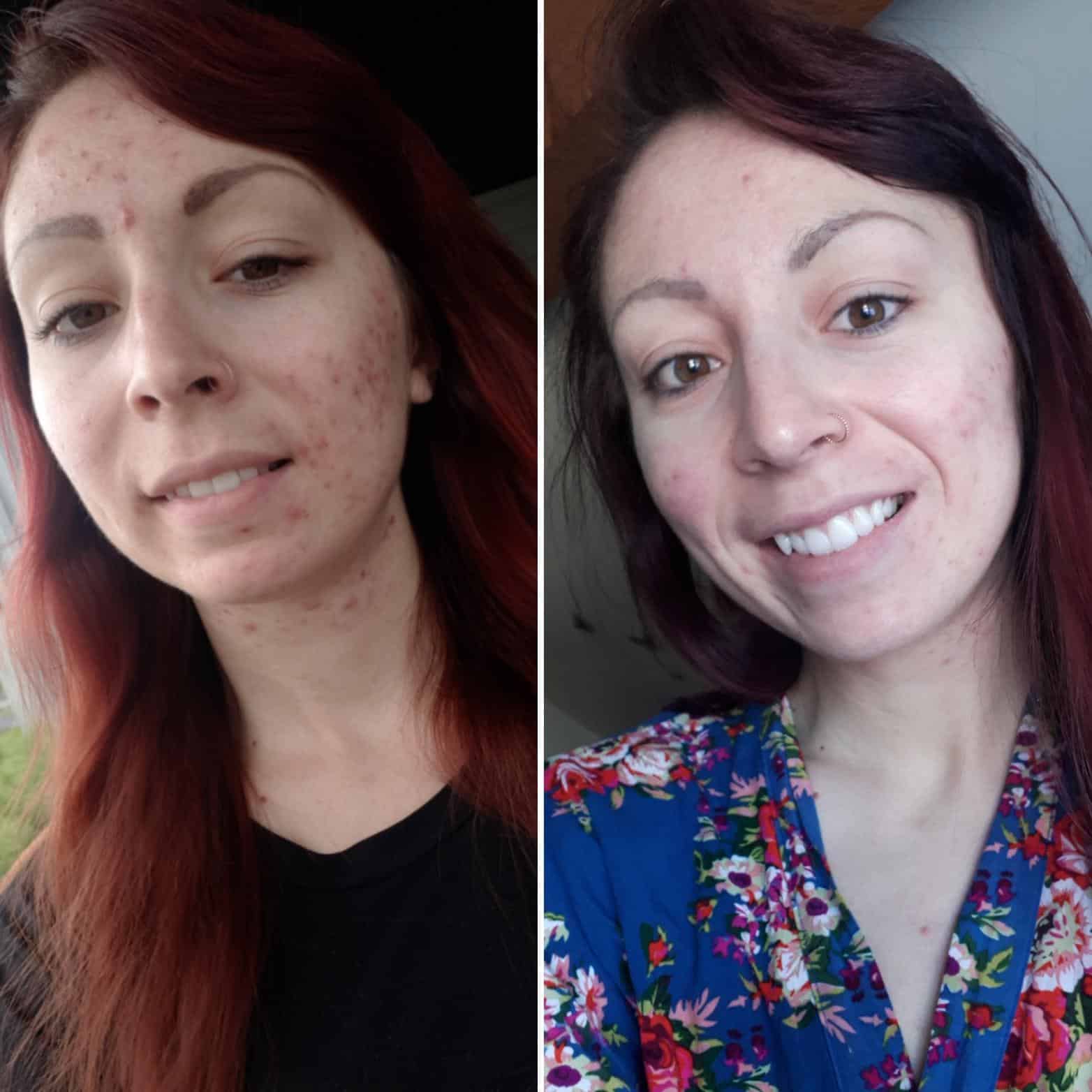 Before/after 6 months of Spiro Aldactone : acne