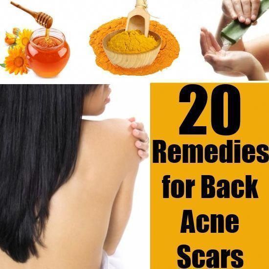 best way to get rid of acne #backacne