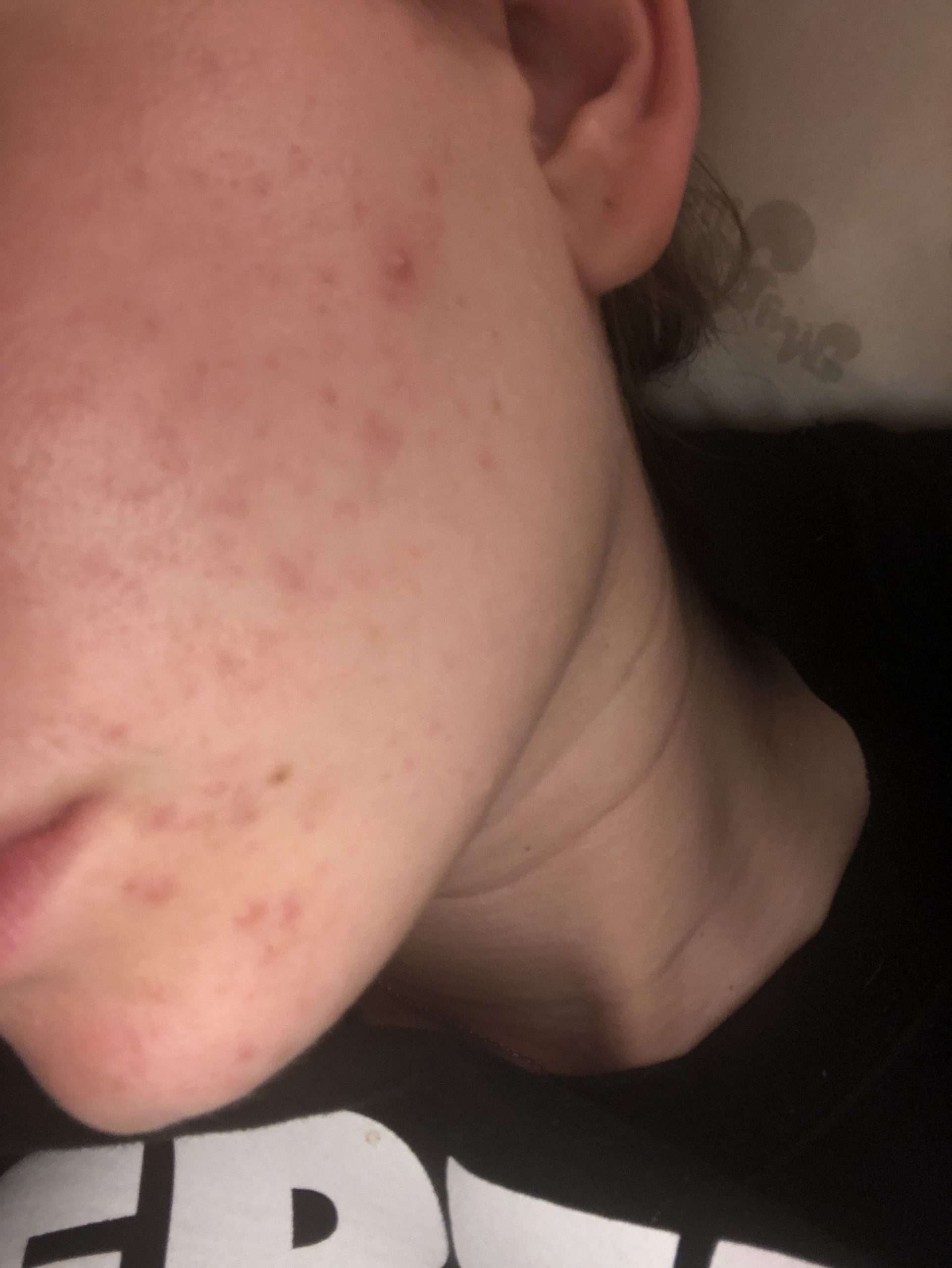 Can anyone tell me what kind of acne I have? Photo included