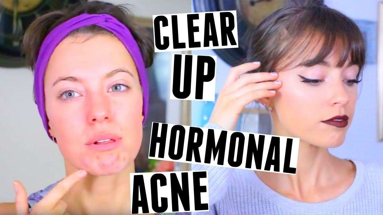 CLEAR UP YOUR HORMONAL ACNE!