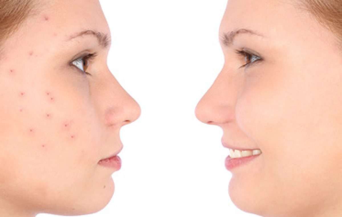 Clear Your Complexion: Traditional Chinese Medicine for Acne