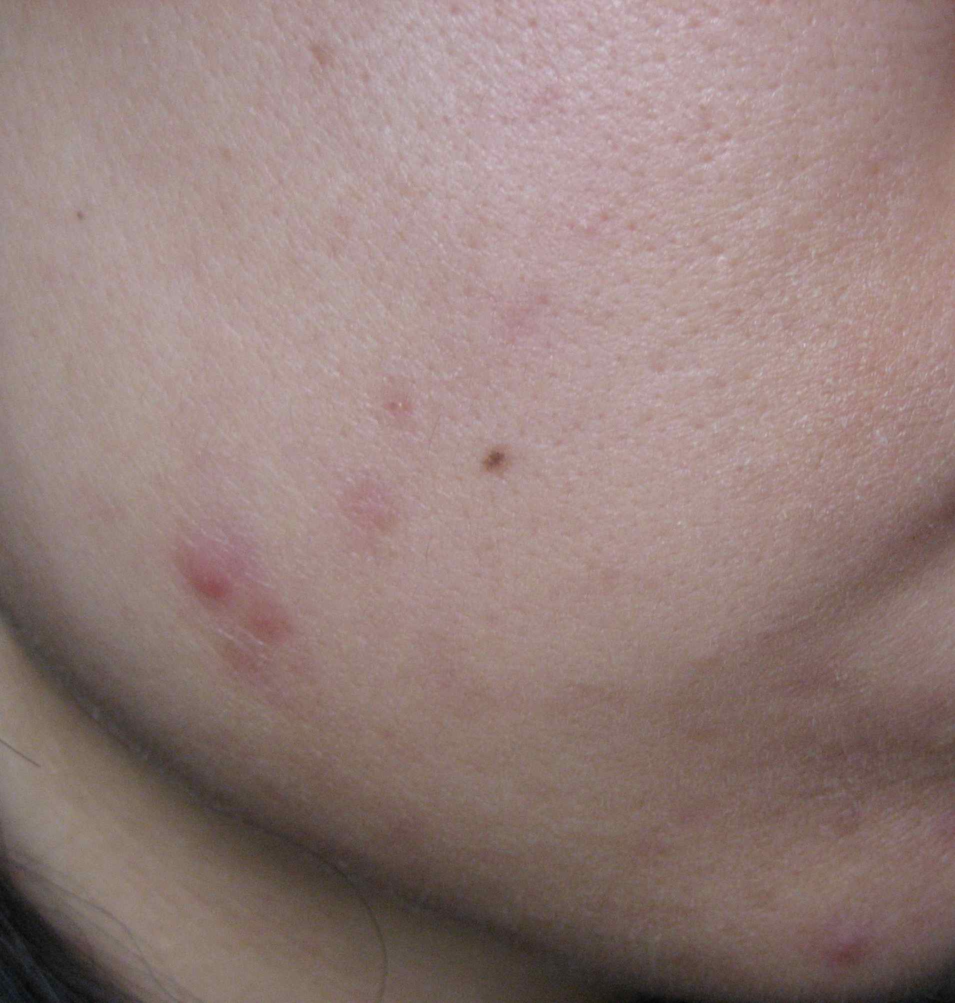 Clearing Chin and Jaw Hormonal Acne