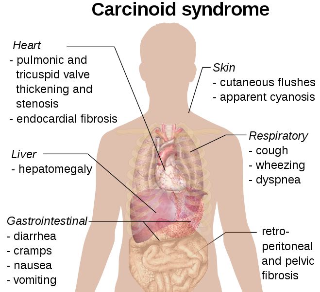 Clinical presentation of the carcinoid syndrome