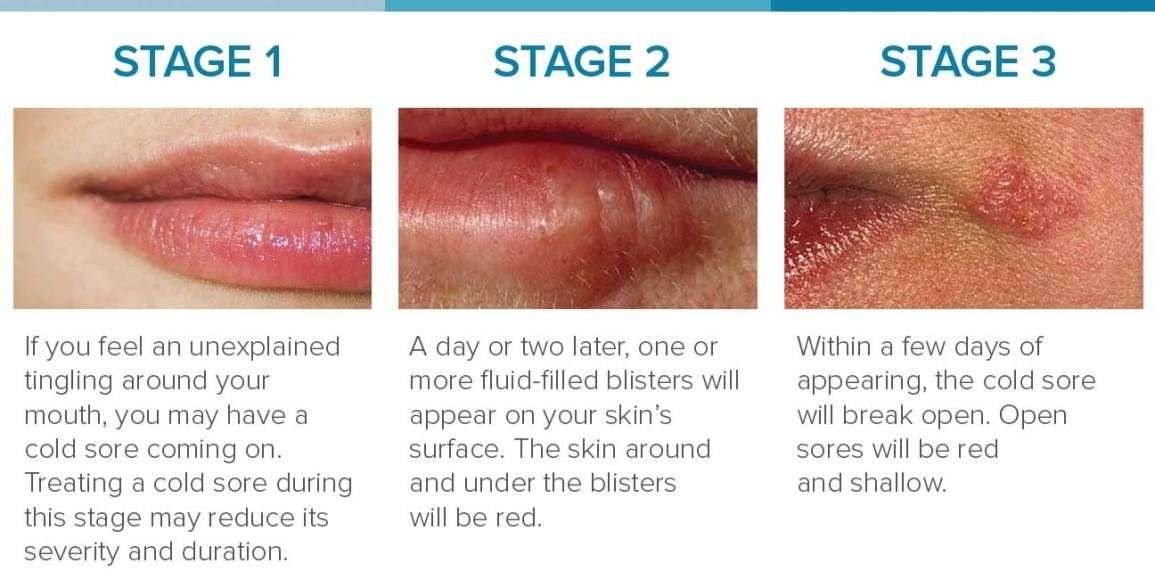 Cold Sore Stages: Identification and Treatment in 2021 ...