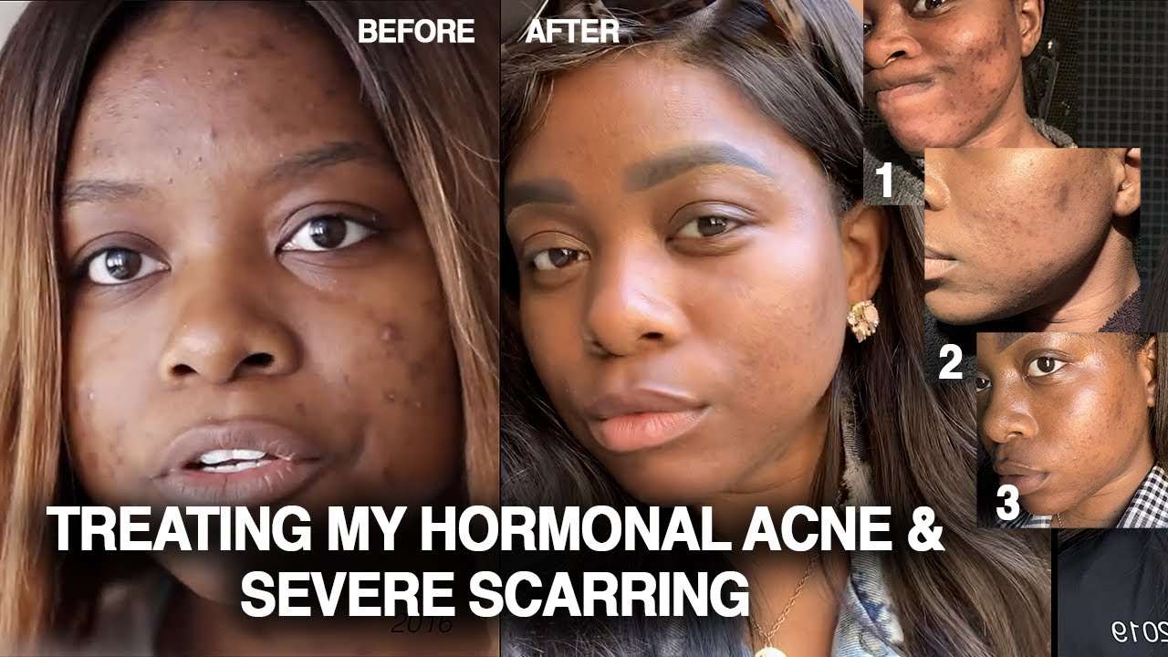 CRAZY HORMONAL ACNE + HYPERPIGMENTATION TREATED WITHOUT BIRTH CONTROL ...