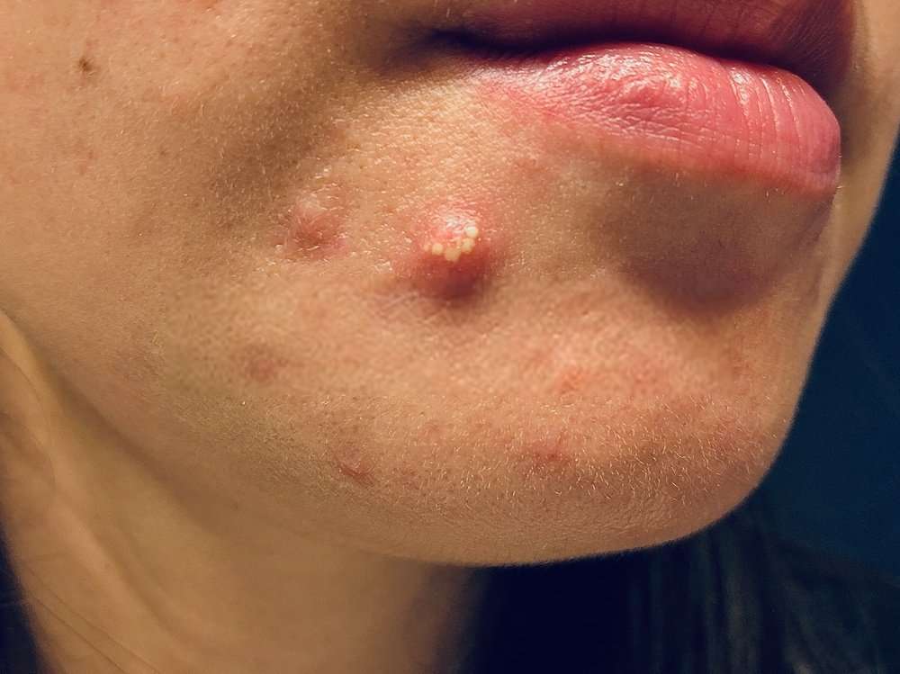 Cystic Acne Around Mouth