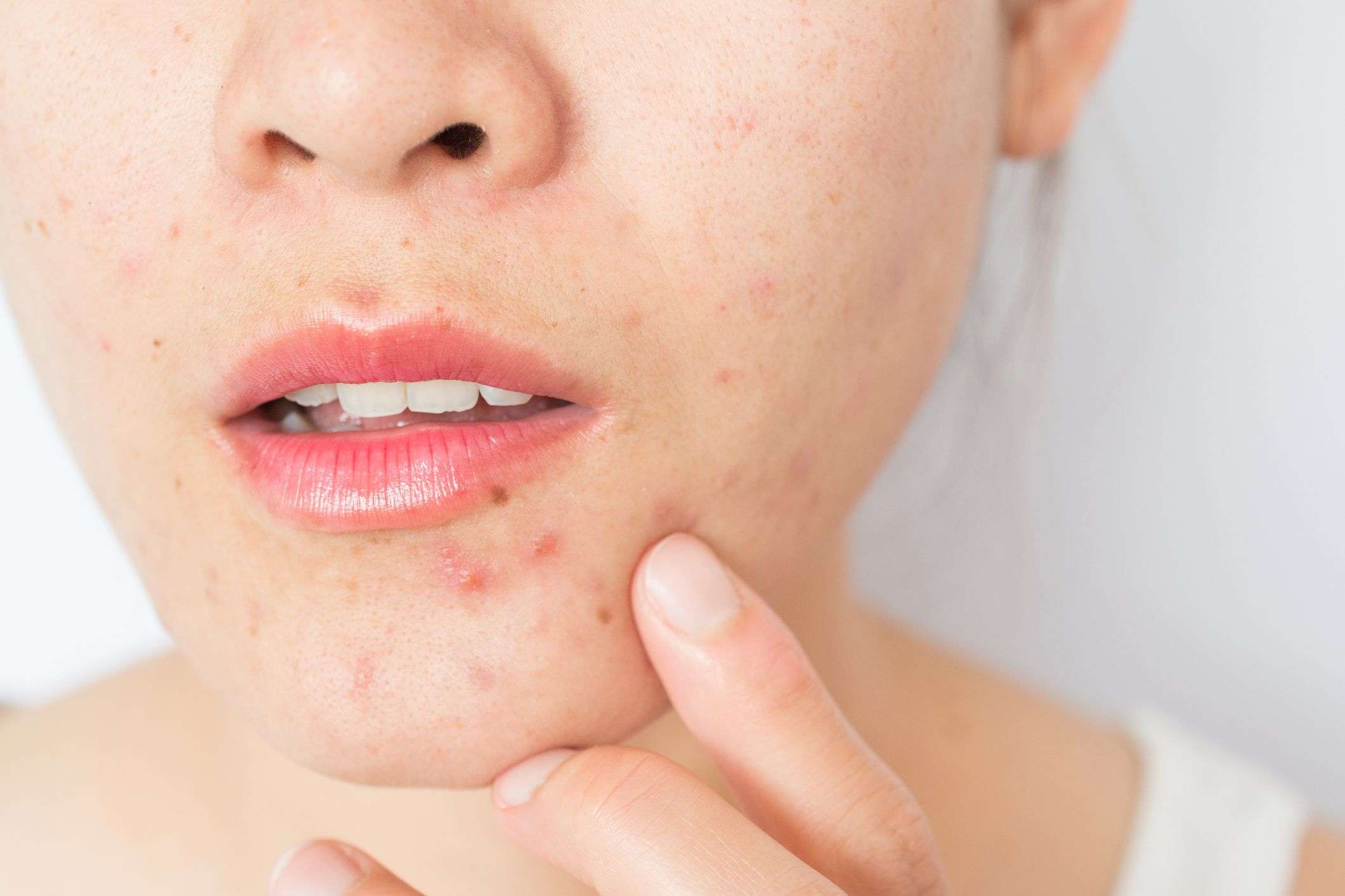 Dermatologists Say This Is How to Treat Hormonal Acne
