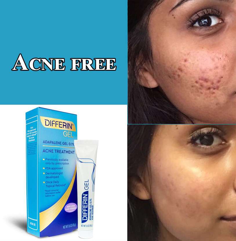 Differin (adapalene) treats acne