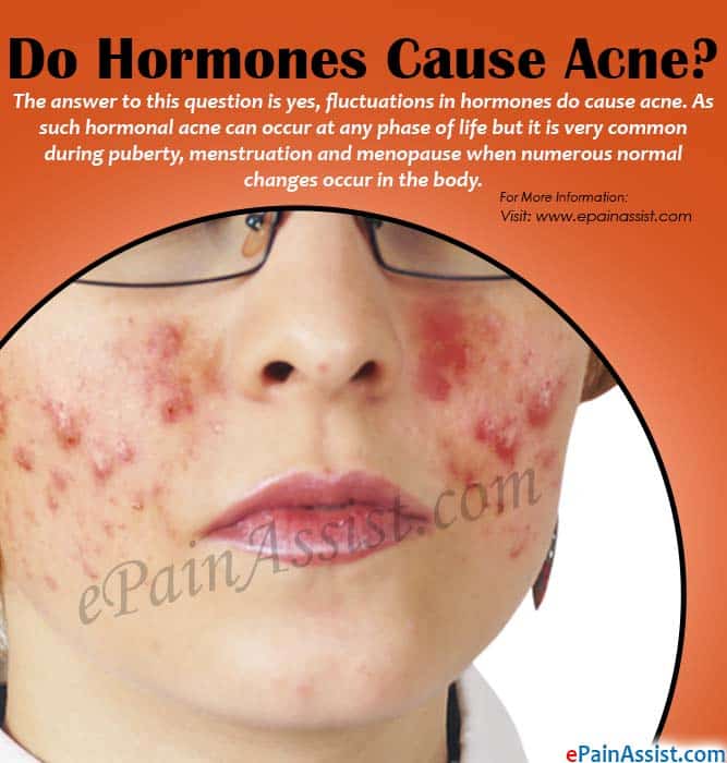 Do Hormones Cause Acne?