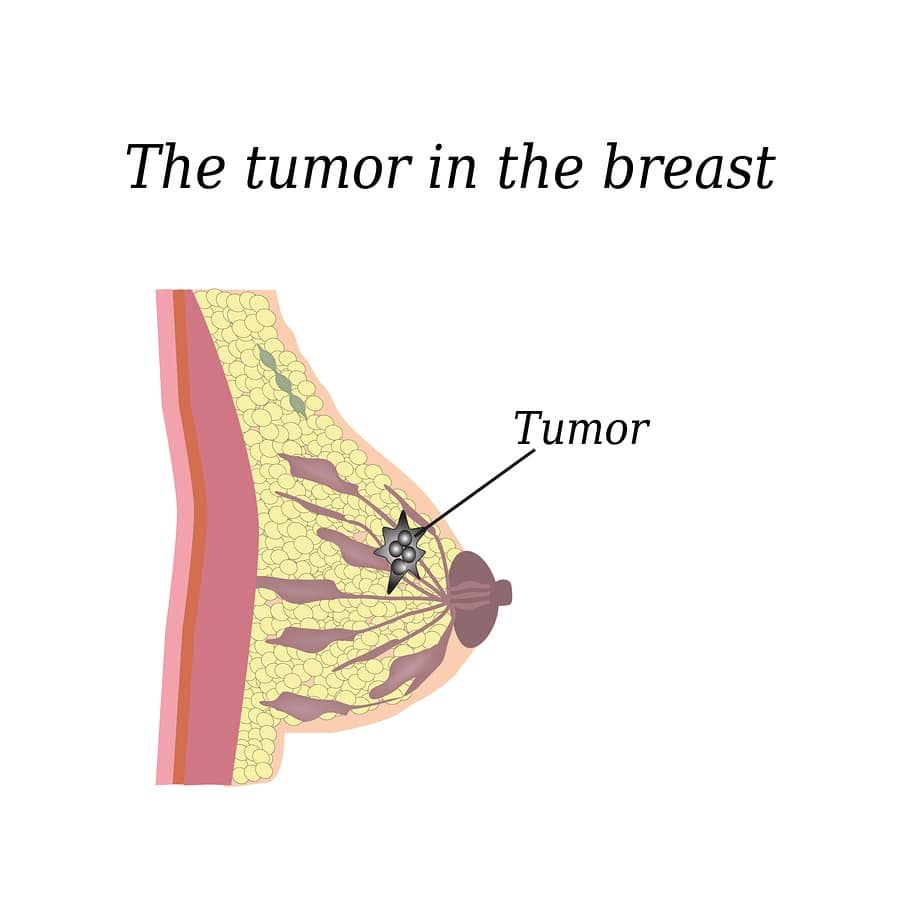 Do you know Breast Cancer? Breast Cancer Quiz