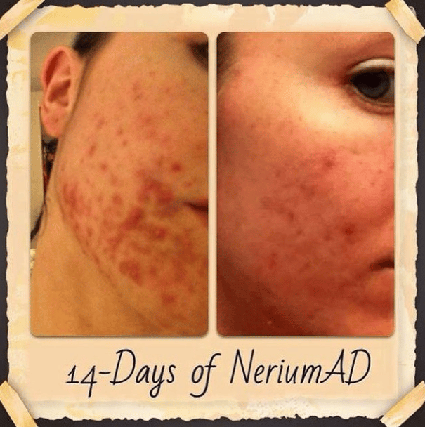 Do you suffer from acne scarring?? If so this is the product for you ...