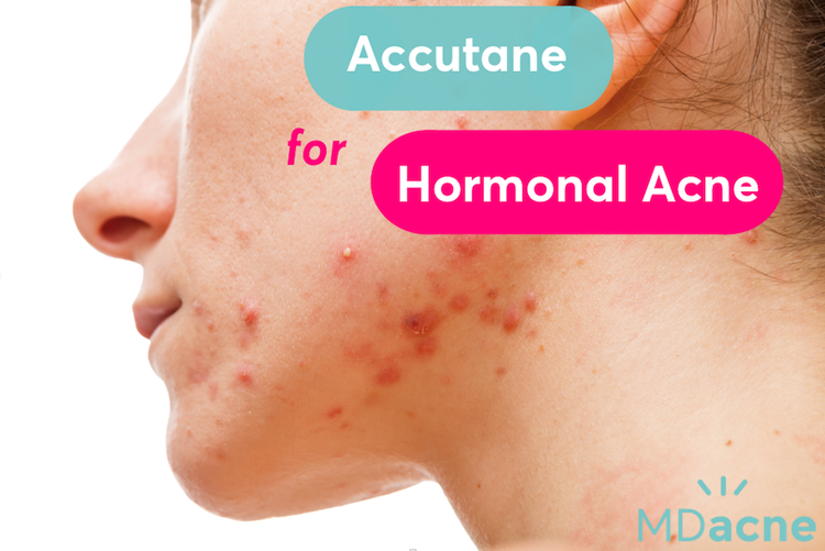 Does Accutane work for hormonal acne? (Acne Help)