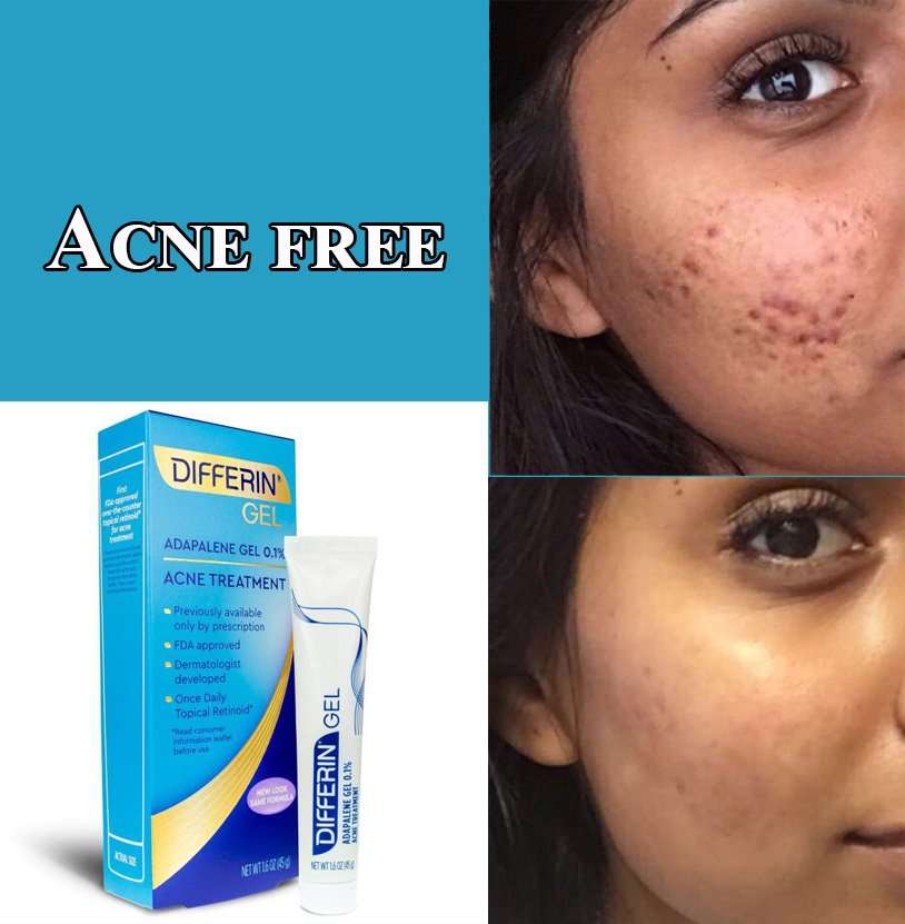 Does Differin Treat Hormonal Acne