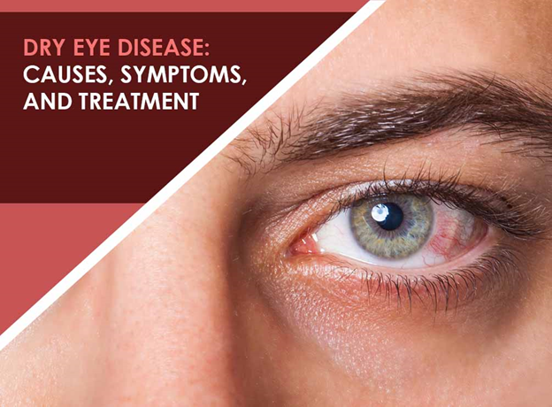 Dry Eye Syndrome: Causes, Symptoms &  Treatment » How To Relief