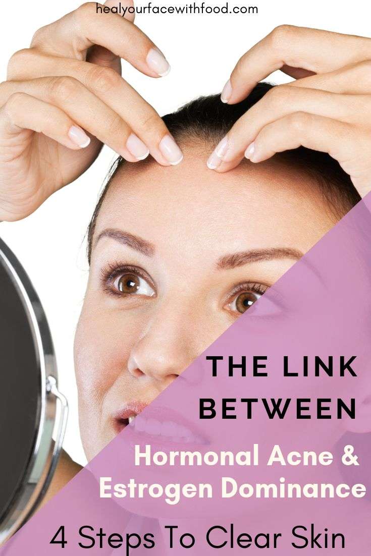 Estrogen dominance and acne