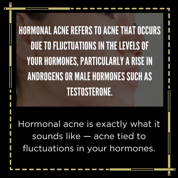 Everything You Need To Know About Hormonal Acne