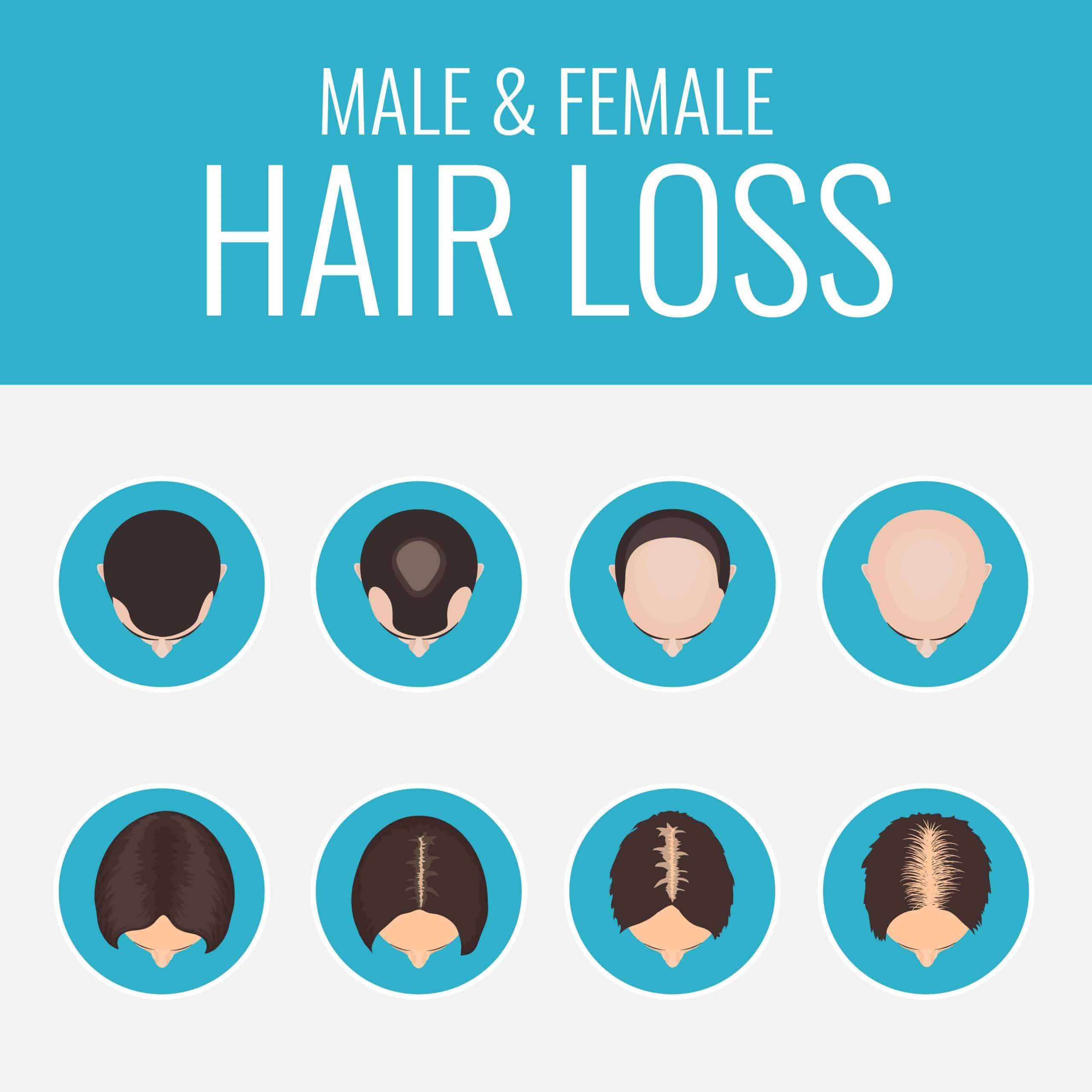 Hair Loss Part 2: Causes of Hair loss: John K McRae, DNP: Wellness Center