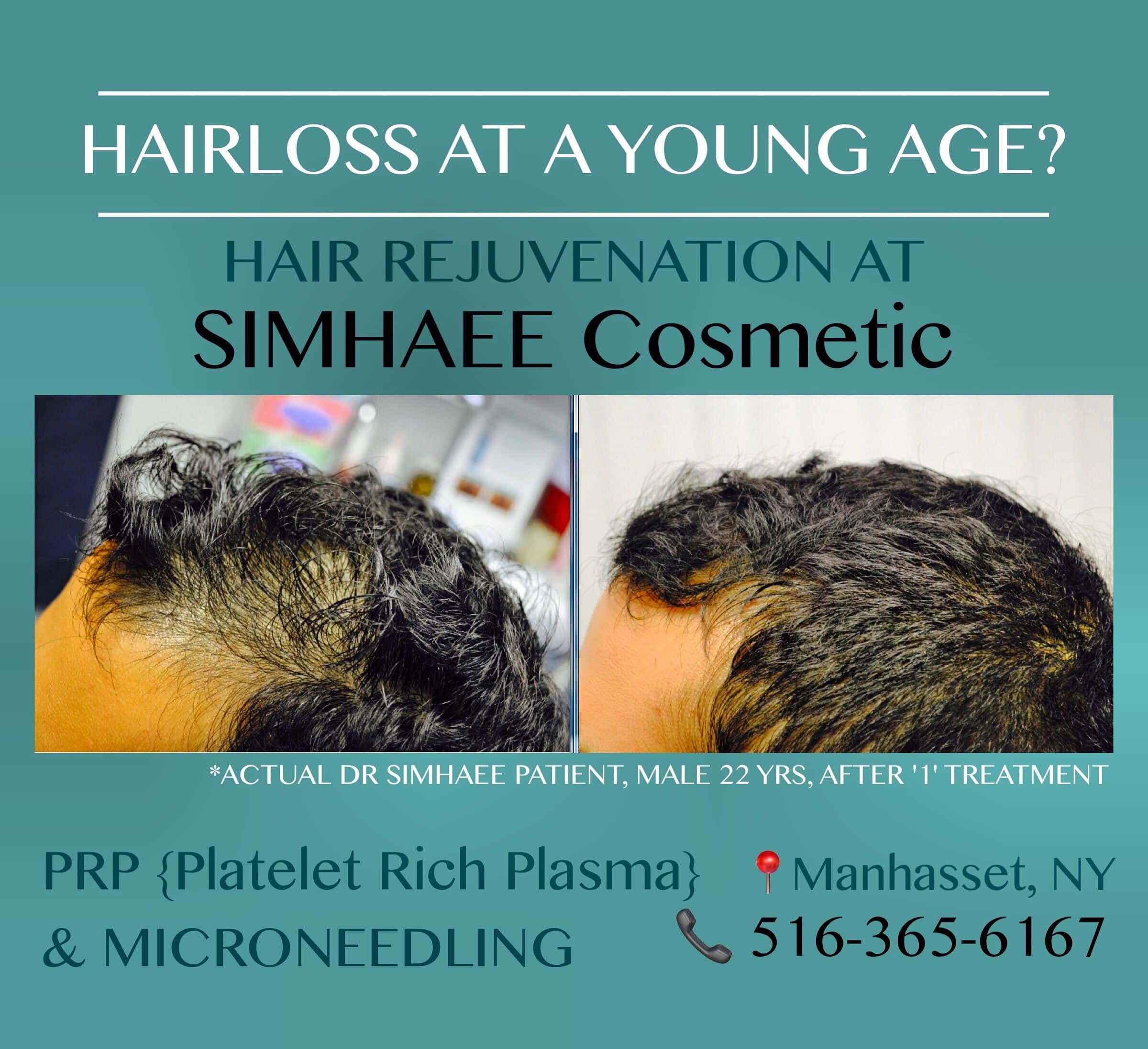 HAIRLOSS at a young age, recommended hair rejuvenation treatments by Dr ...