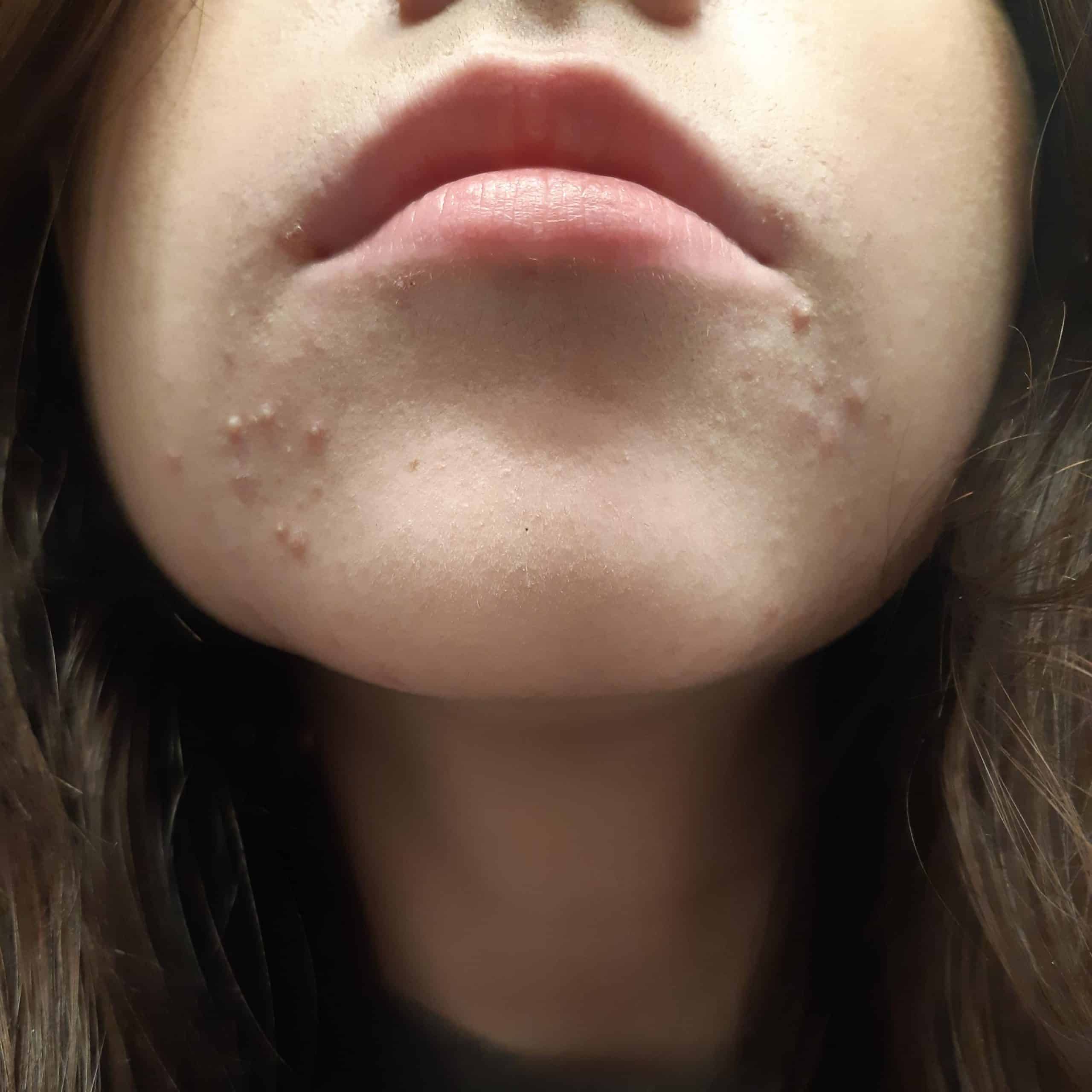 help hormonal acne?? : SkincareAddicts