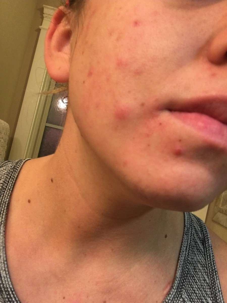 Hormonal Acne: 5 Easy Ways To Get Rid Of It For Good
