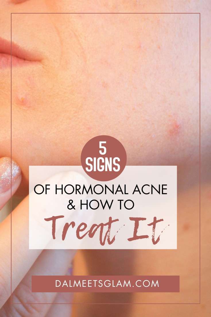 Hormonal Acne: 5 Signs You Are Dealing with It &  How to Treat It