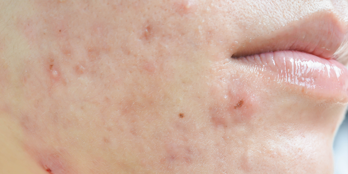 Hormonal Acne: 5 Signs You