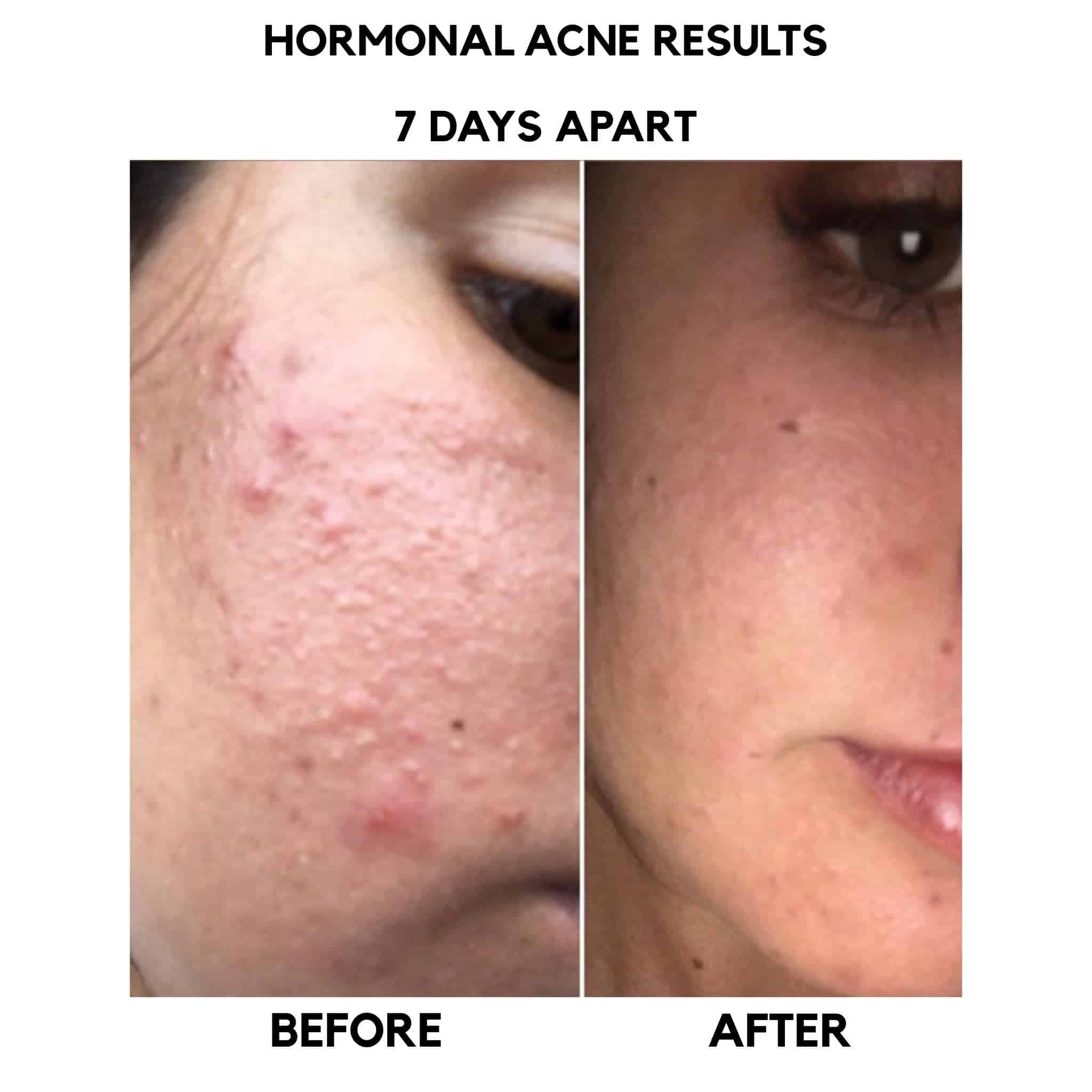Hormonal Acne 7 Days results  Bangn Body
