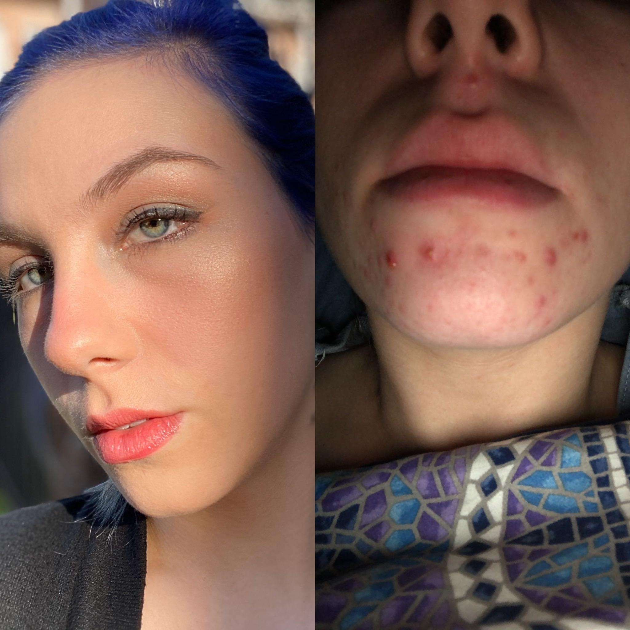 Hormonal acne is finally under control after 10 years :,