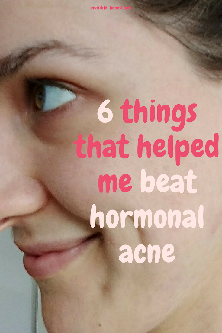 Hormonal acne is hard to get rid of. But it