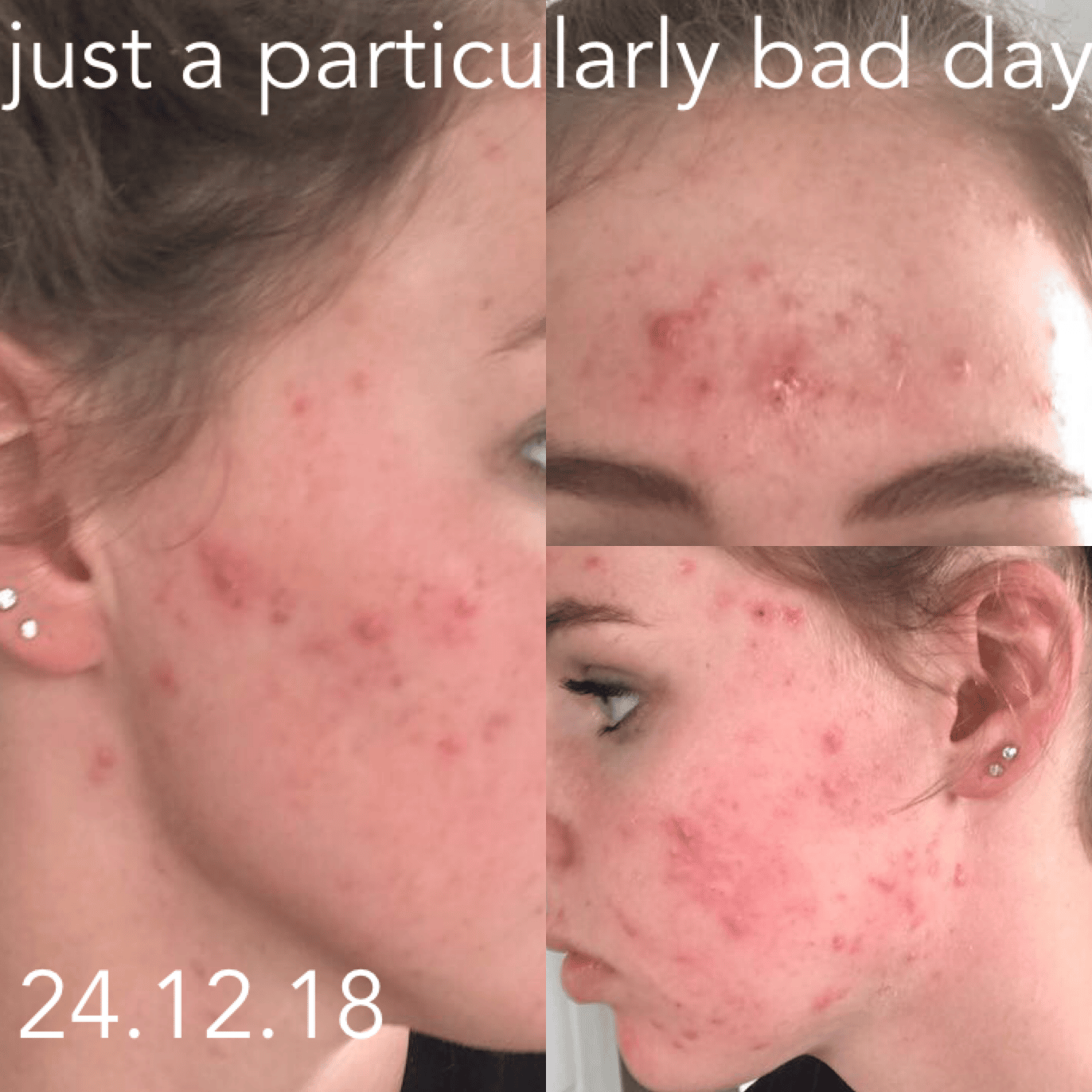 hormonal cystic acne sufferer