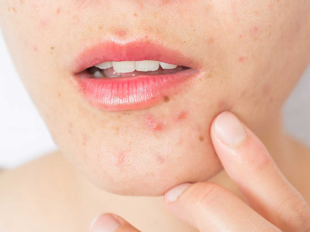 How Can You Treat Hormonal Acne With Natural Remedies ...