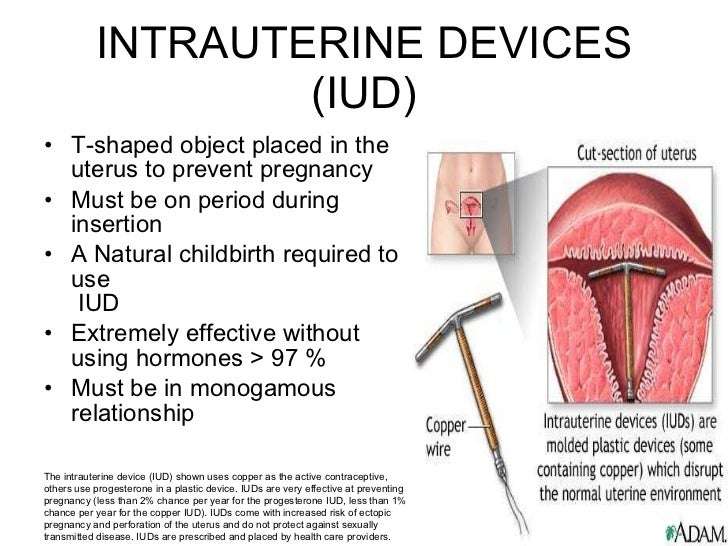 How Effective Are Iuds At Preventing Pregnancy