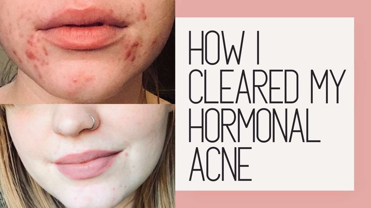 HOW I CLEARED MY HORMONAL ACNE (DRY/SENSITIVE)