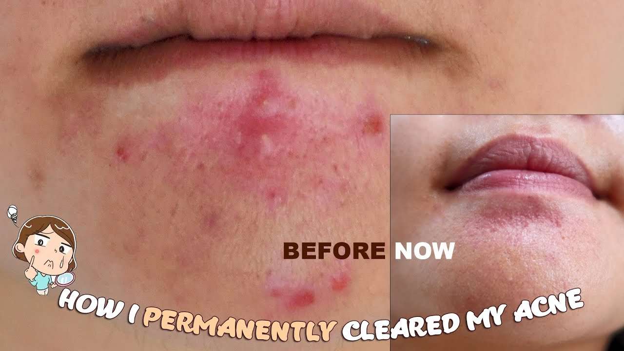 HOW I CLEARED MY HORMONAL CHIN ACNE & ACNE SCARS